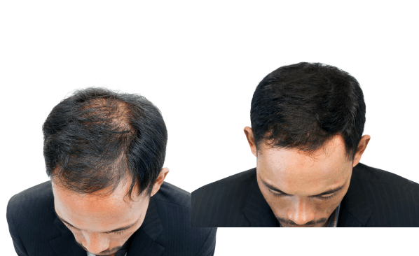 Patient using FitRx for hair loss care online